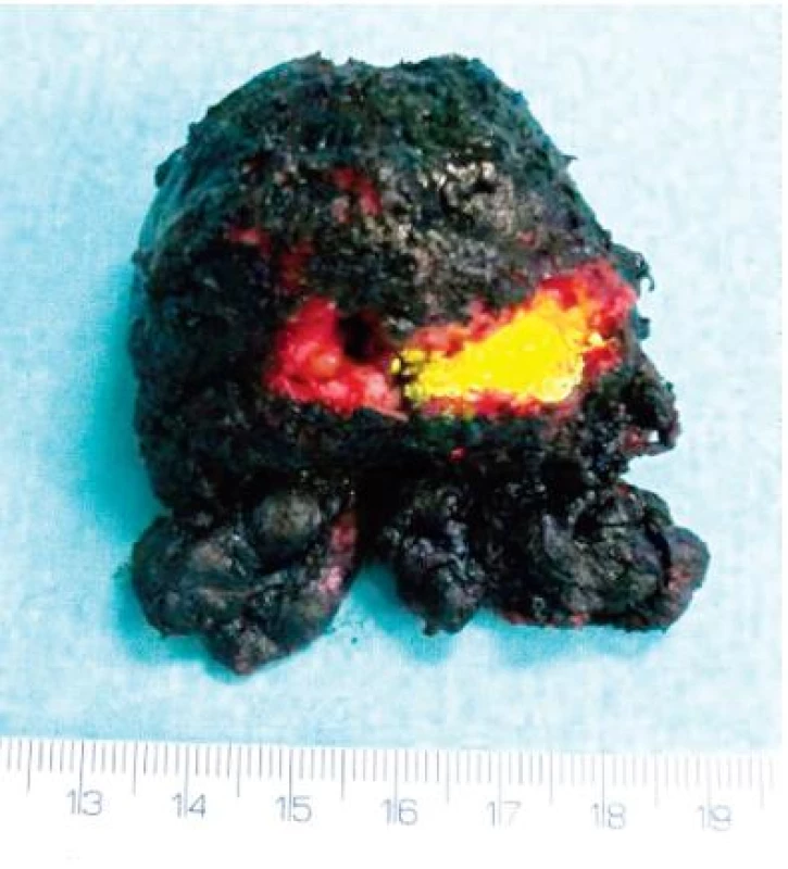 Nativní nefixovaná prostata obarvená inkoustem (žlutou barvou označený arteficiální zářez)
Fig. 1. Native, non-fixed and inked prostatic gland. Artificial incision marked with yellow ink.