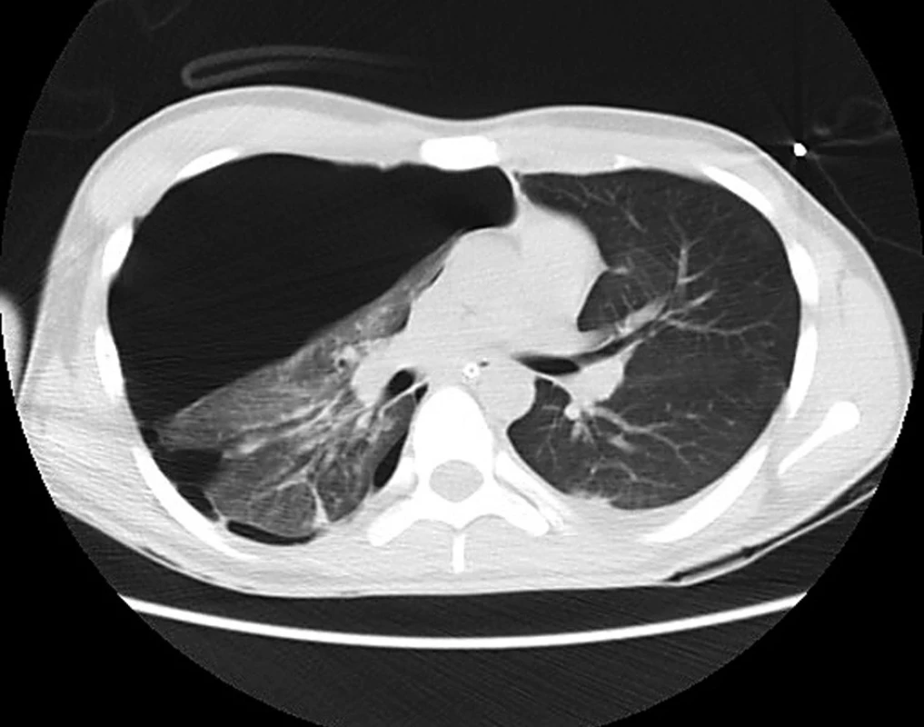 Tenzní pneumotorax vpravo na CT Je vidět zvětšení objemu hemithoraxu a přetlačení mediastina na levou stranu.
Fig. 2: Tension pneumothorax on the right side CT scan; the expansion of the hemithorax volume and the compression of the mediastinum to the left side can be seen.