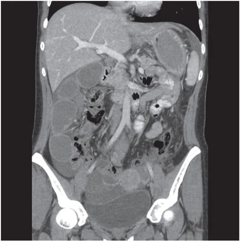 CT: Metastatický infiltrát v oblasti malé pánve
Fig. 2 CT: Metastatic infiltration in the pelvis