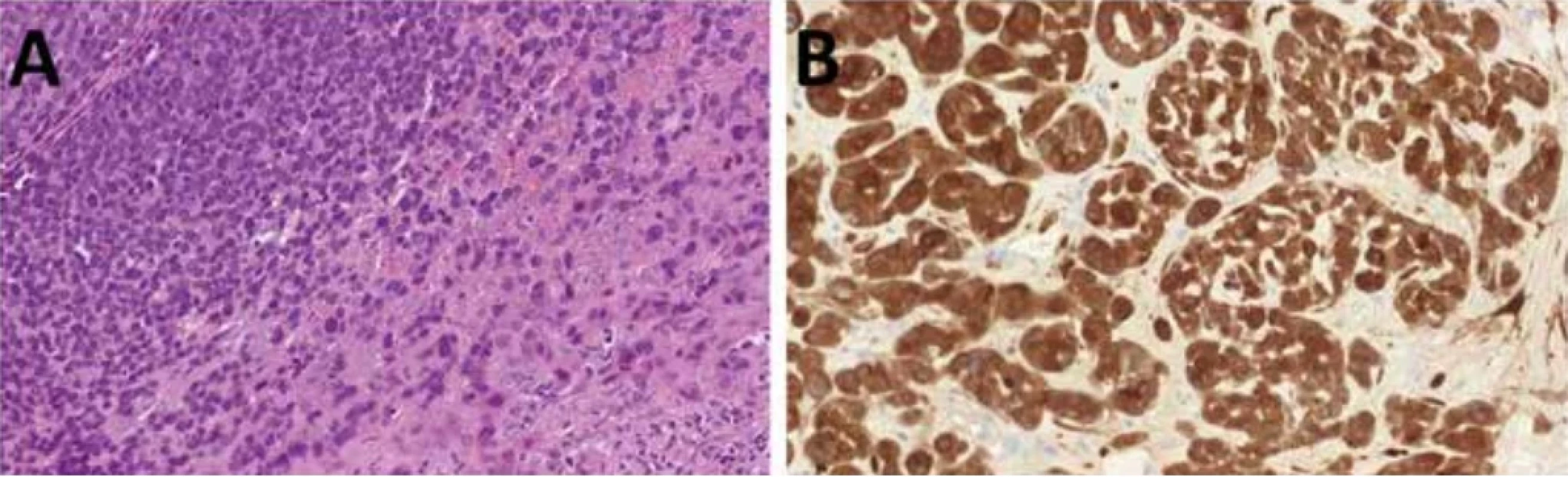 HPV-asociovaný multifenotypický sinonazální karcinom je bifázický nádor obvykle připomínající adenoidně cystický karcinom anebo myoepiteliální karcinom s typicky celulární periferií a méně celulárním centrem přecházejícím v nekrotickou oblast (A). Charakteristická je exprese p16, která by měla být doplněna o pozitivní HPV testaci (B).