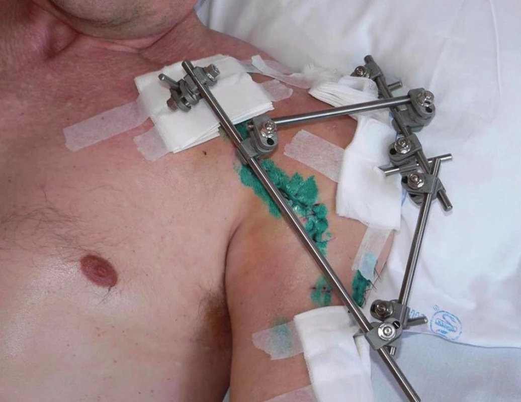 Fotodokumentace pacienta po provedení artrodézy ramenního kloubu (Použit modulární zevní fixatér PH fix Prospon.)
Fig. 2: Photo-documentation of a patient after shoulder arthrodesis (In this case a PH fix Prospon modular external fixation device was used.)