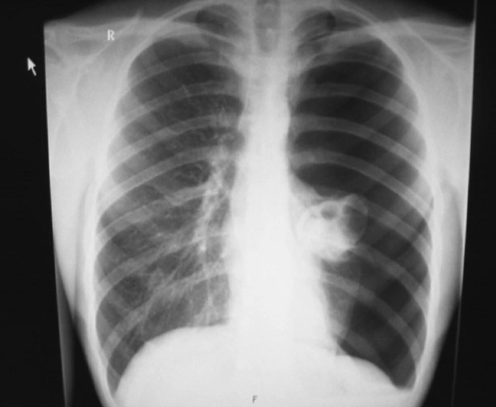 Totální kolaps levé plíce, první recidiva SPNO
Fig. 2. Total pneumotorax, left-sided, first recurrence of SPNO