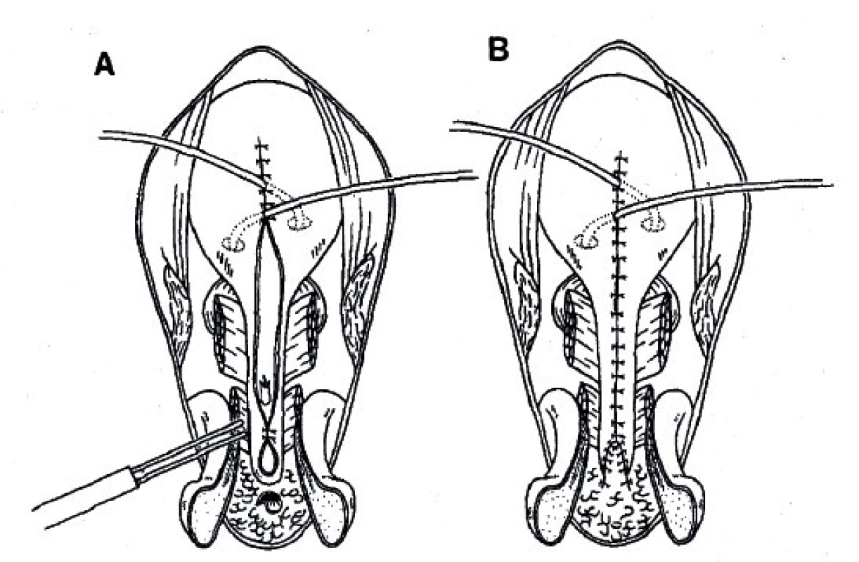 Dokončení plastiky dle Kellyho s rekonstrukcí glandu a kavernózních těles.
Fig. 7. Reconstruction of the glans and cavernous bodies - terminal phase of the operation.