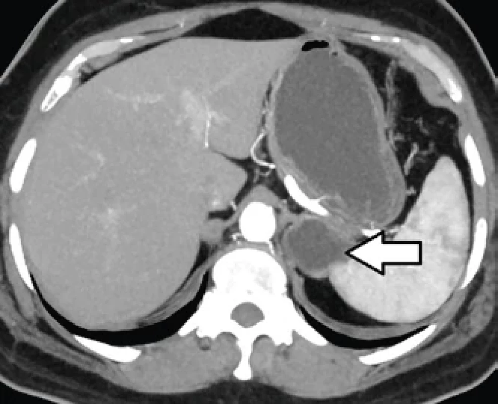 CT obraz žaludečního divertiklu (šipka) – transverzální rovina. CT scan of stomach diverticulum (arrow) – transversal plane.