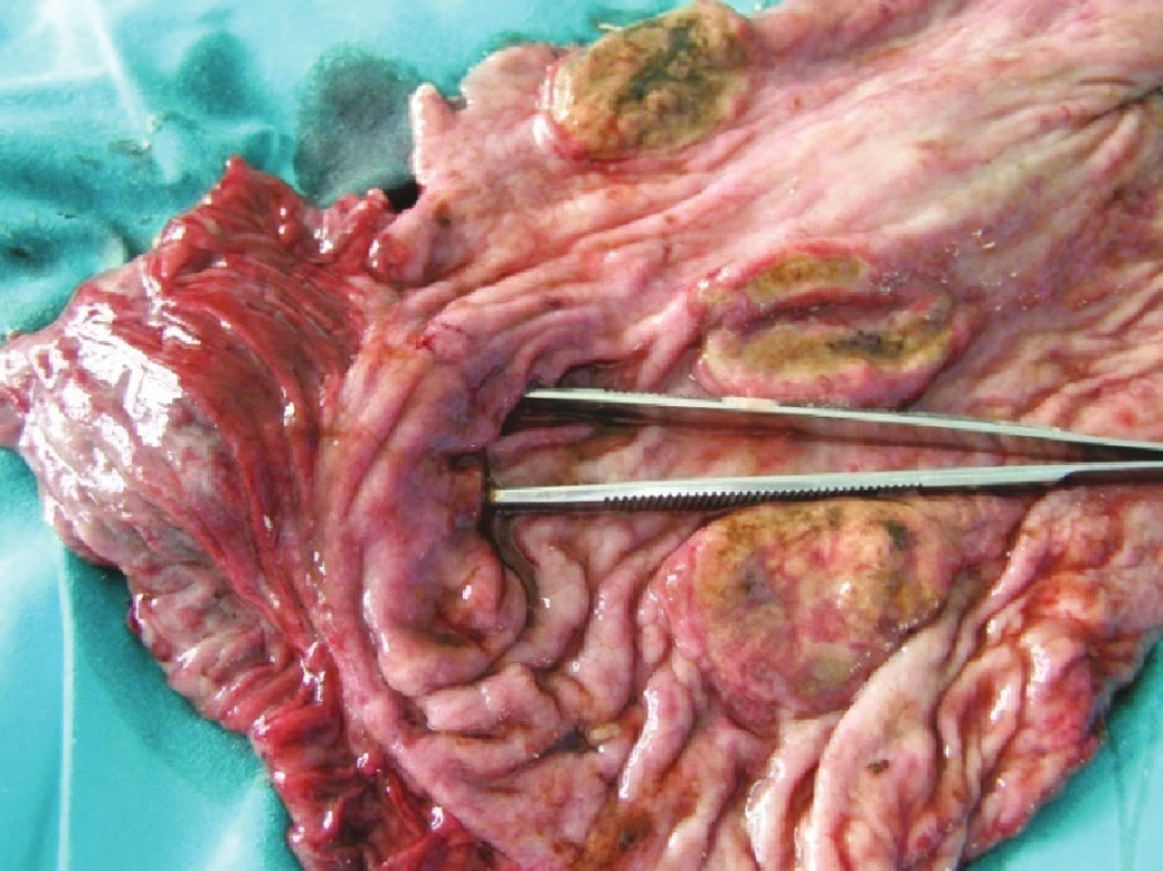 Detail exulcerácii
Fig. 4. Exulceration – a detail view