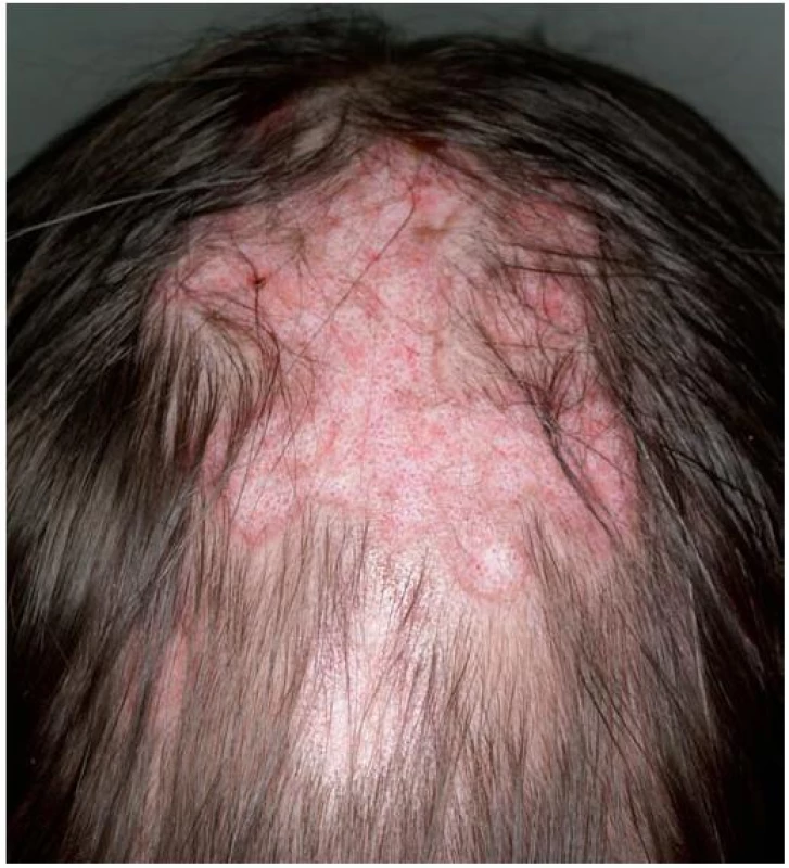 Diskoidní lupus erythematodes