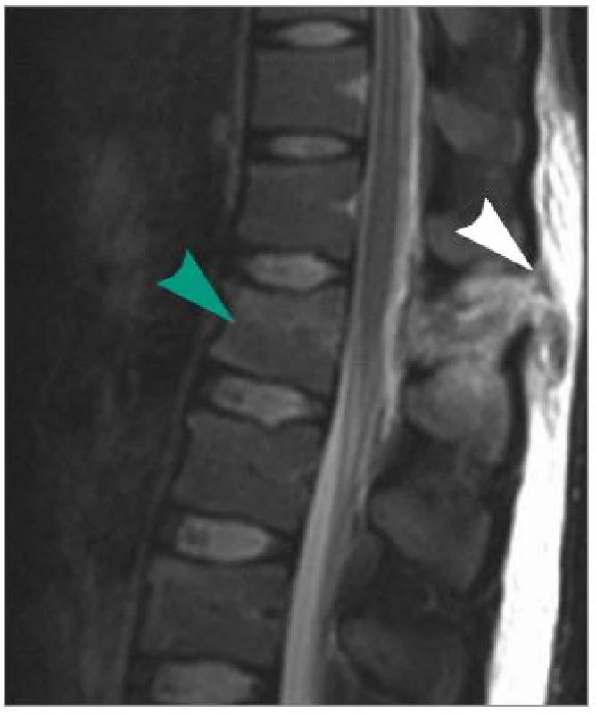 MRI ve STIR zobrazení v sagitální rovině ve střední čáře. Bílá šipka označuje roztržení supraspinózního a interspinózního vazu Th12/L1. Hyperintenzivní ložisko v okolí ZVK je známkou edému a hematomu. Zelená šipka označuje hyperintenzivní, tedy poraněnou horní polovinu obratlového těla L1.