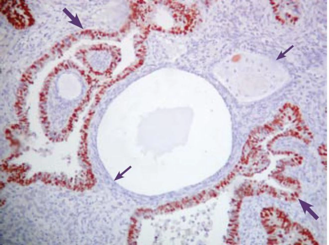 Pravidelne silne pozitívna expresia Ki-67 (červenohnedo) v SC (hrubá šípka). Neprítomnosť expresie Ki-67 v cystickom AE (v menopauze) (tenká šípka). Imunohistochemické vyšetrenie s protilátkou proti Ki–67. ABC-Px, 100×.