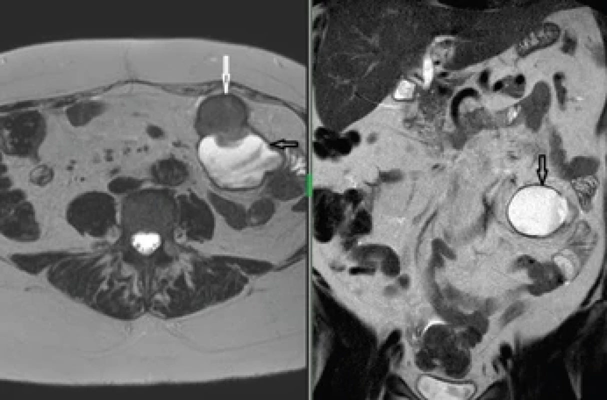 MR snímek tumoru. Fig. 4. MRI scan of the tumour.