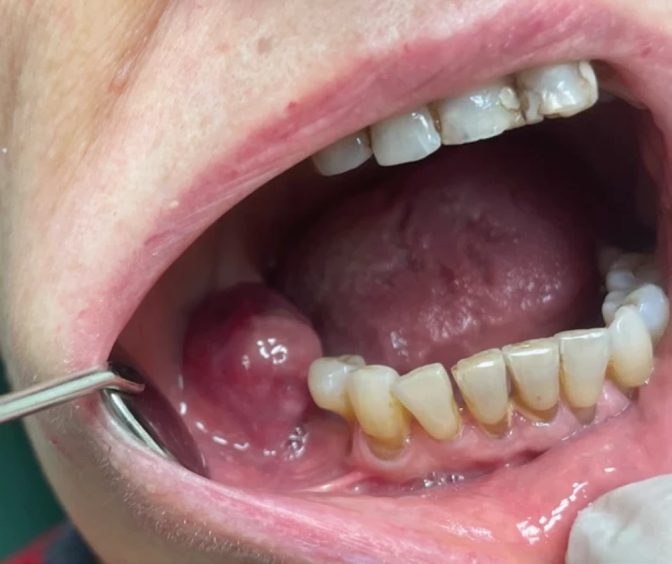 Klinický nález při prvním vyšetření. Patologická exofyticky rostoucí tkáň v místě extrahovaného zubu 47.