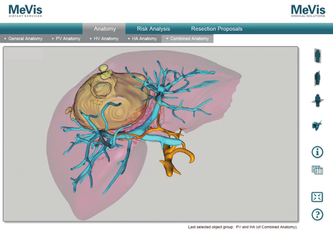 MeVis analýza tumoru, arteria hepatica a vena portae, pacient č. 2
Fig. 6: MeVis analysis of tumor, hepatic artery and portal vein, patient No. 2