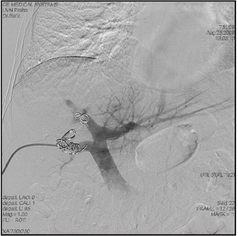 Předoperační embolizace pravostranných větví (přední a zadní sektor) trifurkace portální žíly
Fig. 6: Preoperative embolisation of the right branches of the portal vein trifurcation