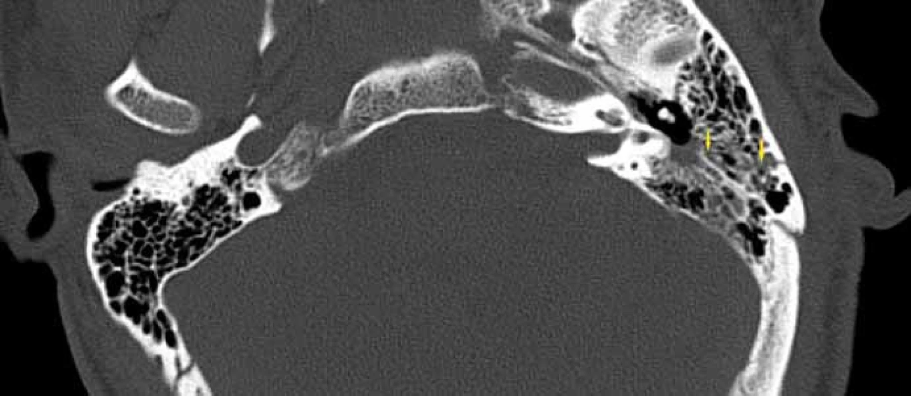 Longitudinální fraktura spánkové kosti, HRCT, axiální rovina.
Fig. 1. Longitudinal fracture of temporal bone, HRCT, axial plane.