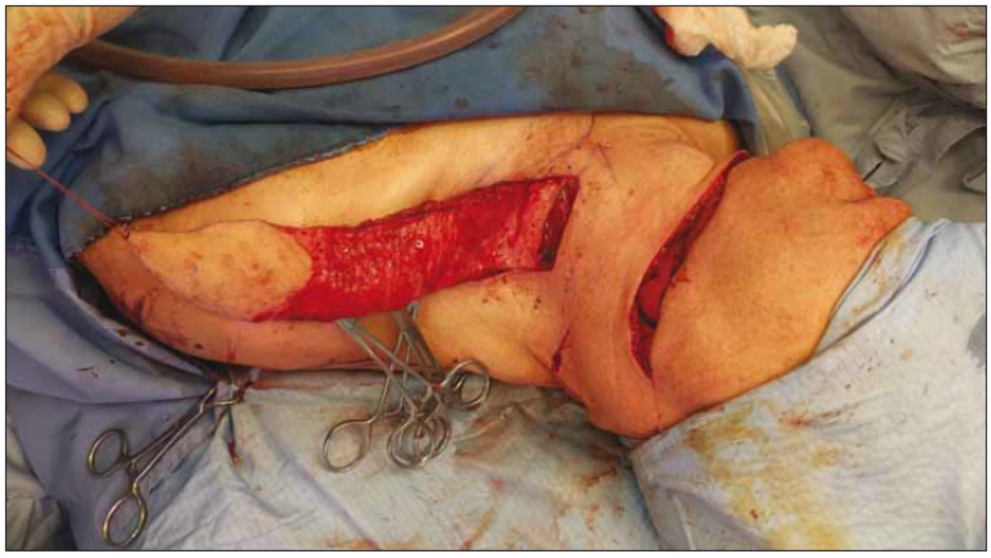 Elevace laloku (pacient č. 1).<br>
Fig. 3. Elevation of the flap (patient No. 1).