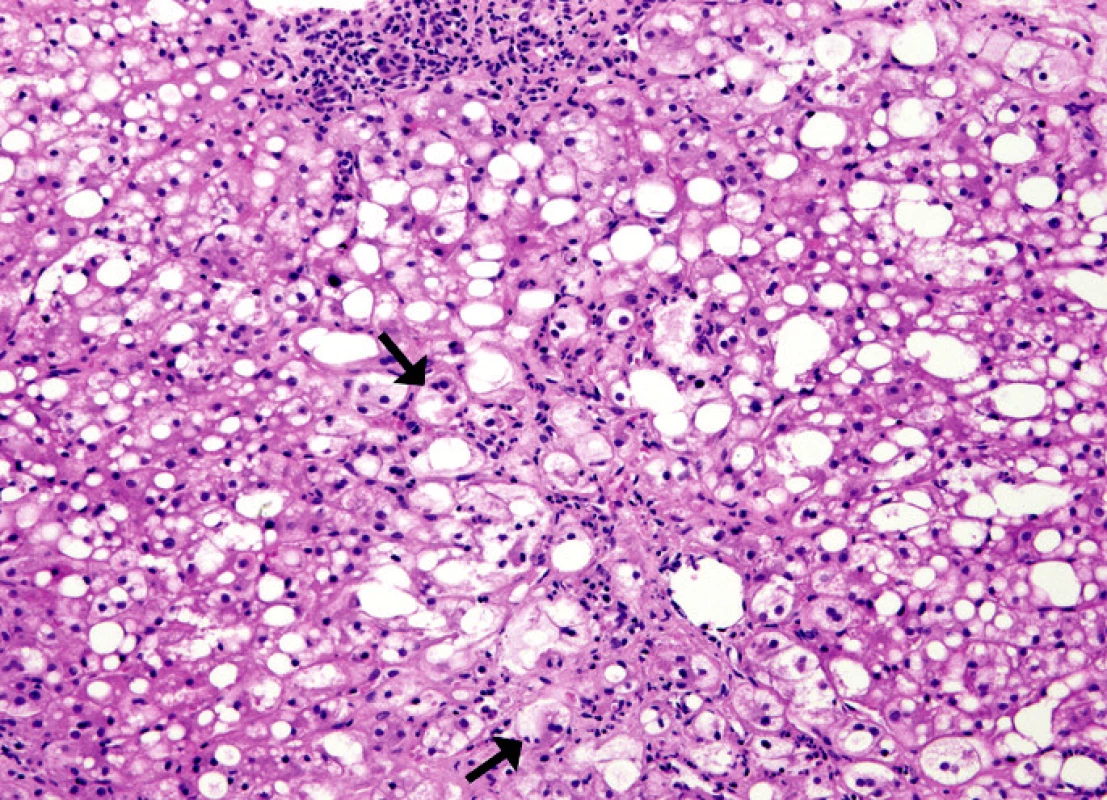 Alkoholická hepatitis s balónovitým zduřením hepatocytů, které obsahují Malloryho hyalin (viz šipky). V okolí hepatocytů s Malloryho hyalitem je zánětlivá infiltrace neutrofilními leukocyty. HE, 250x.