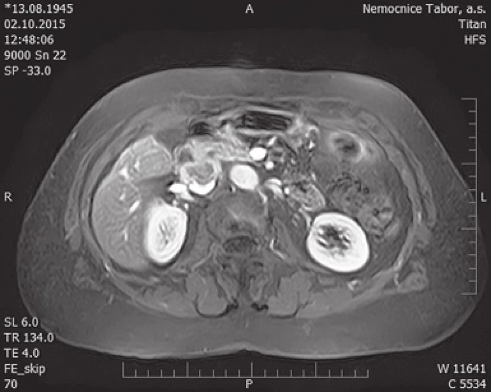 Horizontální řez magnetické rezonance v místě tumoru s patrnou invazí do vena cava inferior
Fig. 3: MRI horizontal cross section with the secondary tumor invading inferior caval vein visible