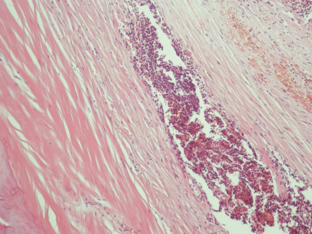 Pseudocysta sleziny v histologickém obrazu
Fig. 6. Histology of the pseudocyst of the spleen