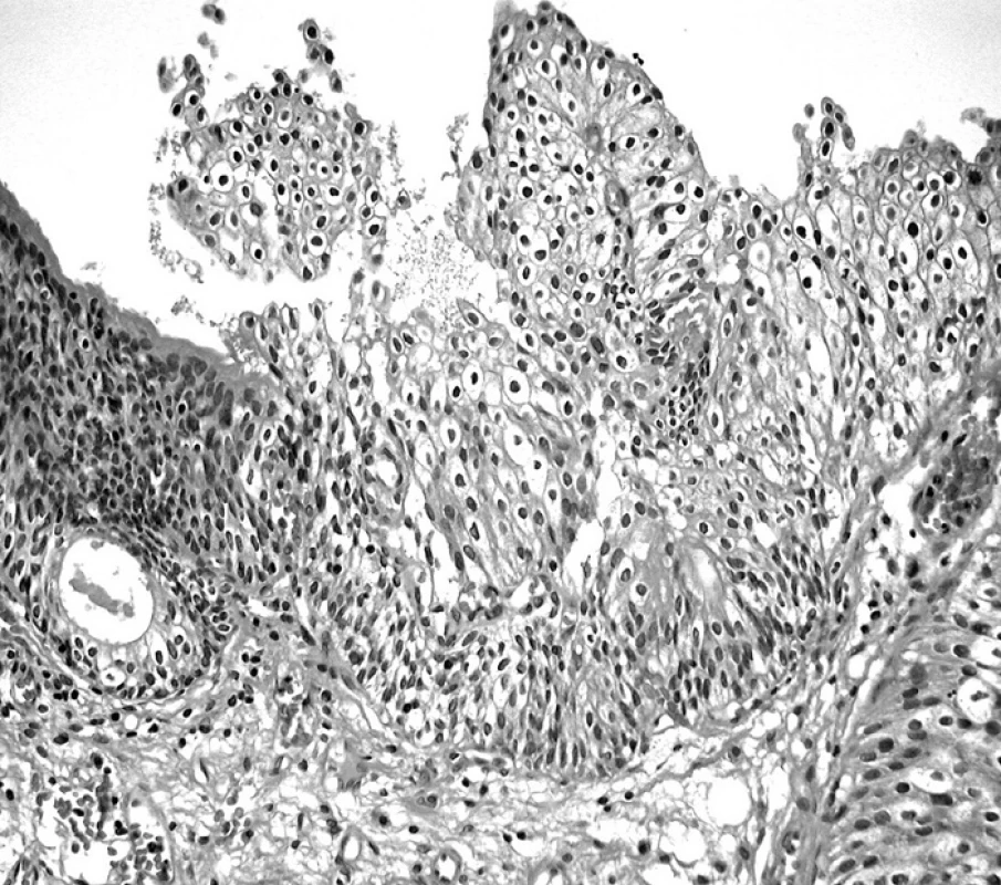 LG papilokarcinom a HG intrauroteliální neoplazie (HE, 100krát)