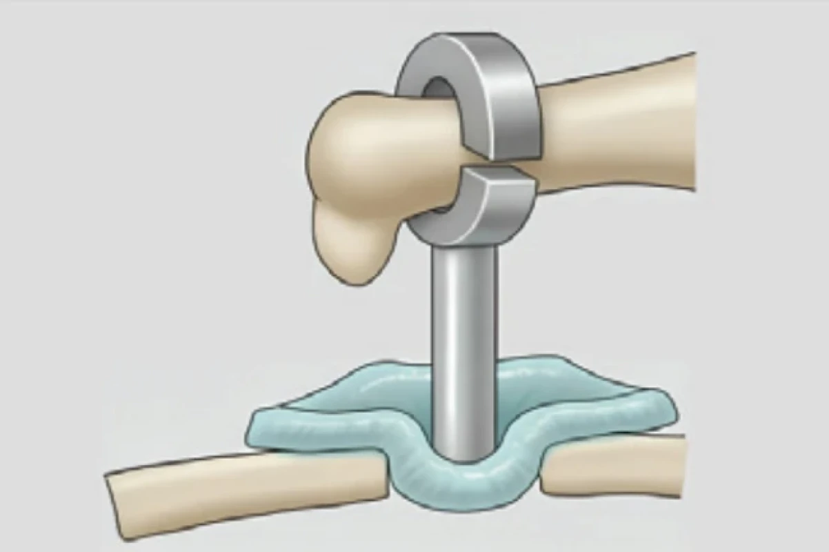 Schéma utěsnění fenestrace pomocí perichondria a pistonu. Schéma použito se souhlasem autora (doc. R. Salzman). Fig. 5. Diagram of fenestration sealing using perichondrium and a piston. The scheme reproduced with permission from the author (Assoc. Prof. R. Salzman).