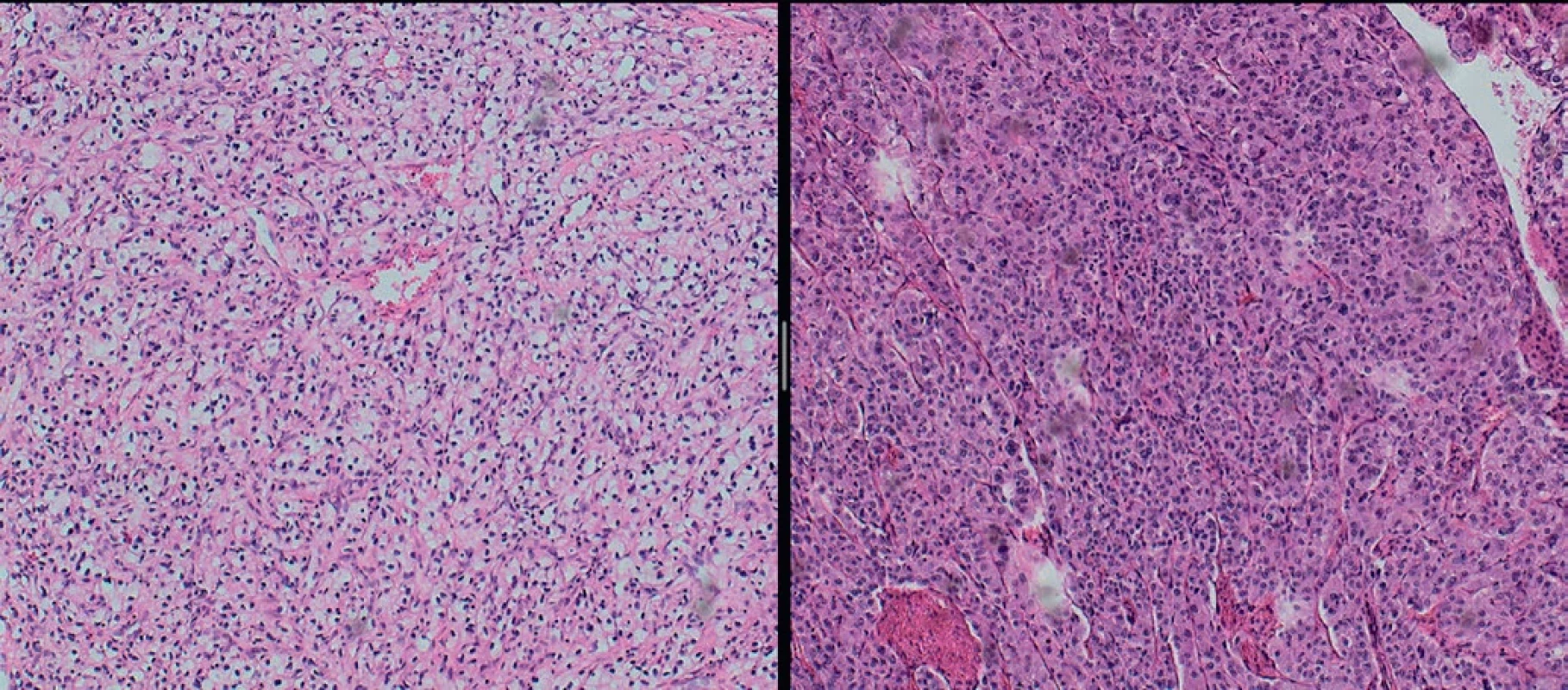 A) Clear cell carcinoma of the kidney with solid trabecular growth suggestive of a pseudoglandular arrangement. B) pheochromocytoma of the adrenal gland showing the so-called “zellballen” growth pattern.