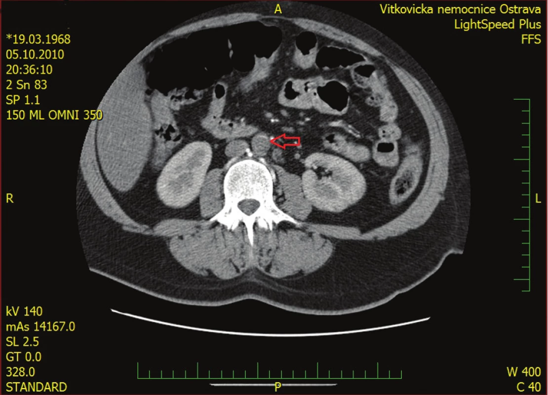 Trombus v břišní aortě
Fig. 1: Thrombus in the abdominal aorta