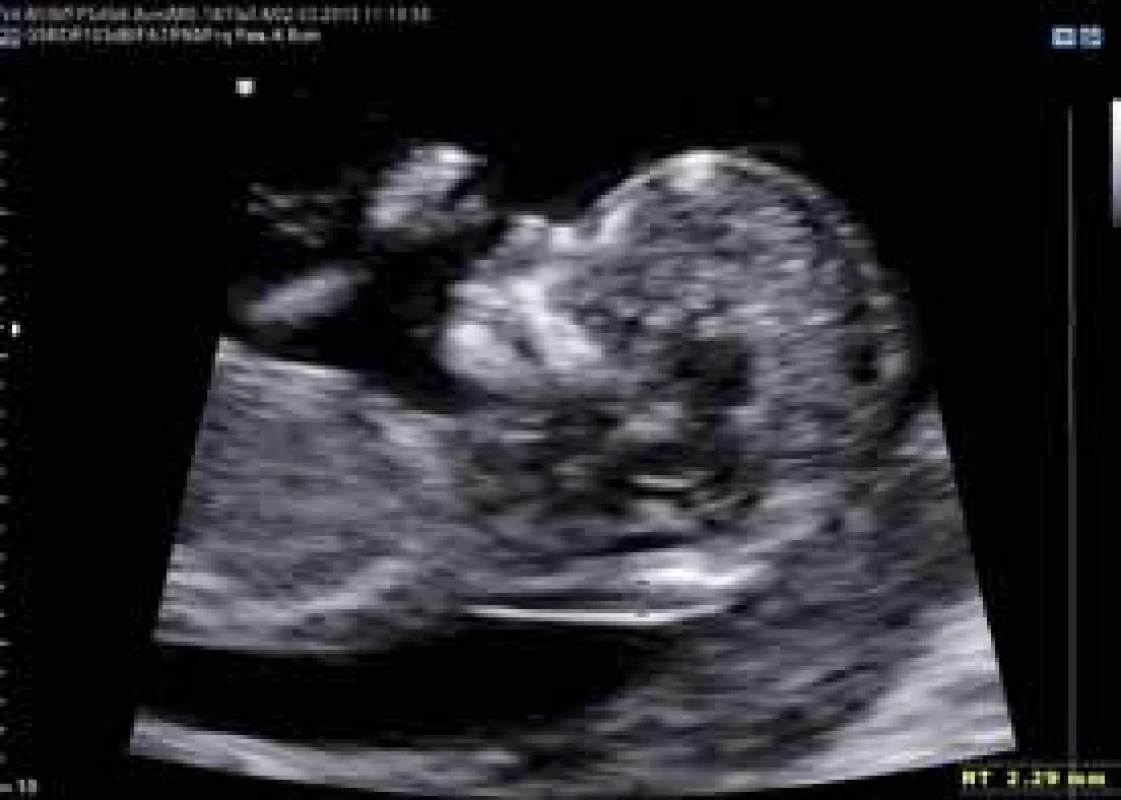 Ultrasonografické vyšetření nuchální translucence dle FMF protokolu (normální nález)