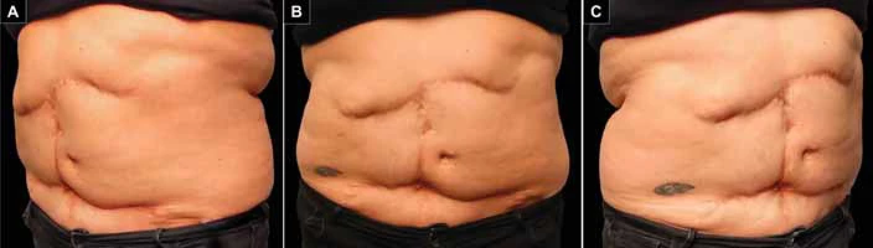 Postoperative control at 5 years. A) Right oblique view; B) frontal view; C) left oblique view.