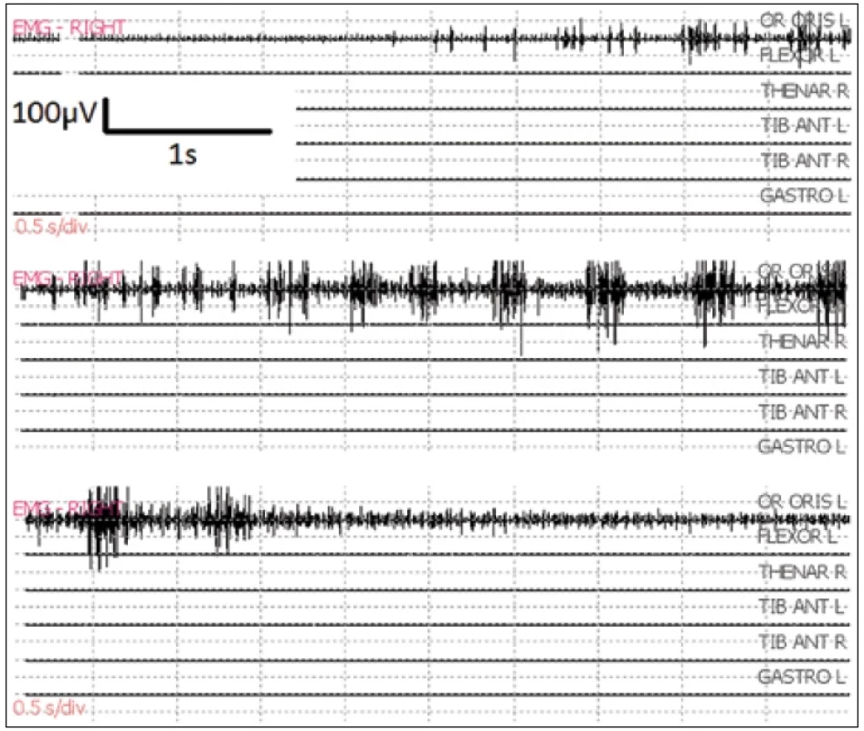 Fokálny epileptický záchvat po bipolárnej stimulácii 50 Hz v oblasti gyrus praecentralis. Je lokalizovaný v jednom monitorovanom svale (m. orbicularis oris), ustúpil do 10 sekúnd po aplikácii ľadového Ringer roztoku na mozgový kortex.
