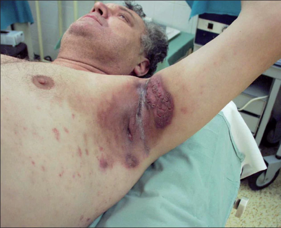 Axilární hidradenitis suppurativa – těžká forma
Postižená kůže je indurovaná, tmavě zbarvená a zánětlivě infiltrovaná. Přítomné jsou zánětlivé uzly, abscesy a podkoží prostupují píštěle hnisavě secernující na povrch.