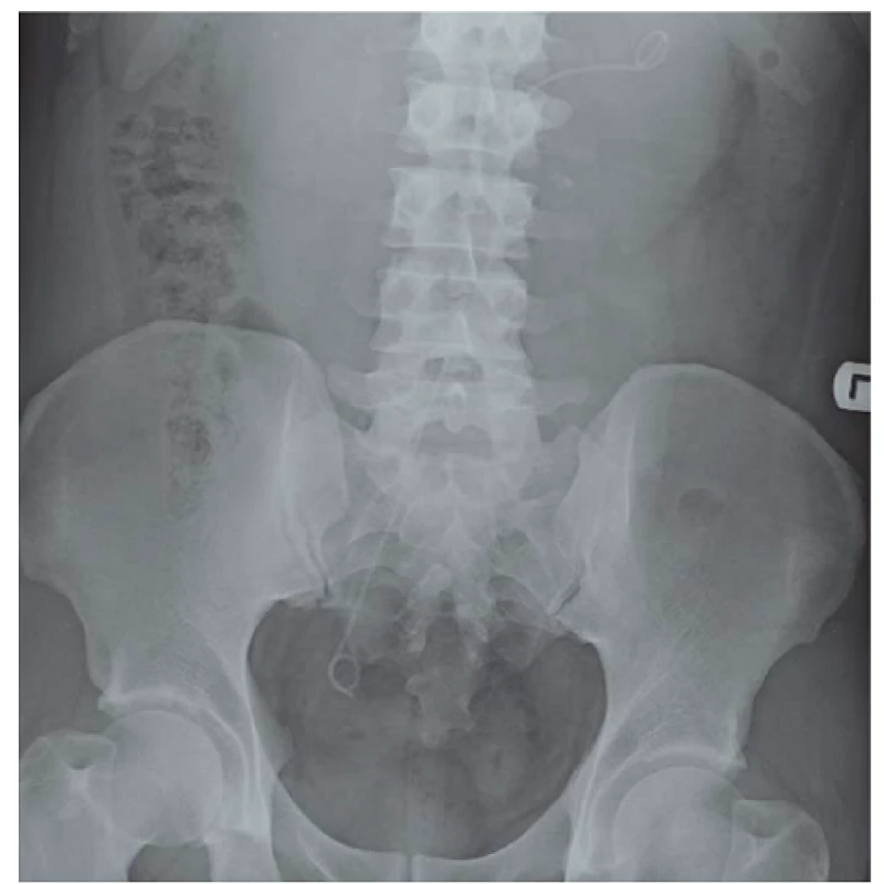 RTG vyšetření. Double J stent zavedený v jediném zkříženém močovodu.