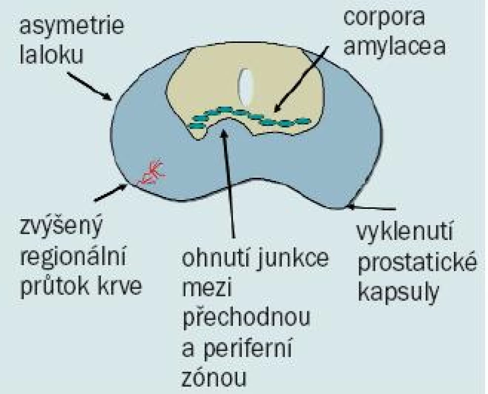 Nálezy ultrazvukového vyšetření prostaty nasvědčující potenciální přítomnosti karcinomu prostaty.