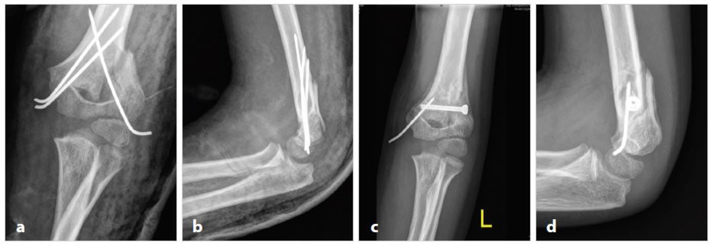 a,b: Atypická suprakondylická zlomenina s vylomením radiálního pilíře (typ 5a), léčena neúspěšně standardní osteosyntézou zkříženými K-dráty
Fig. 3a,b: Atypical supracondylar fracture with radial pillar breakdown (type 5a), standard osteosynthesis using crossed K-wires failed
Obr. 3c,d: Atypická osteosyntéza kanylovaným šroubem
Fig. 3c,d: Non-typical osteosynthesis using cannulated screw