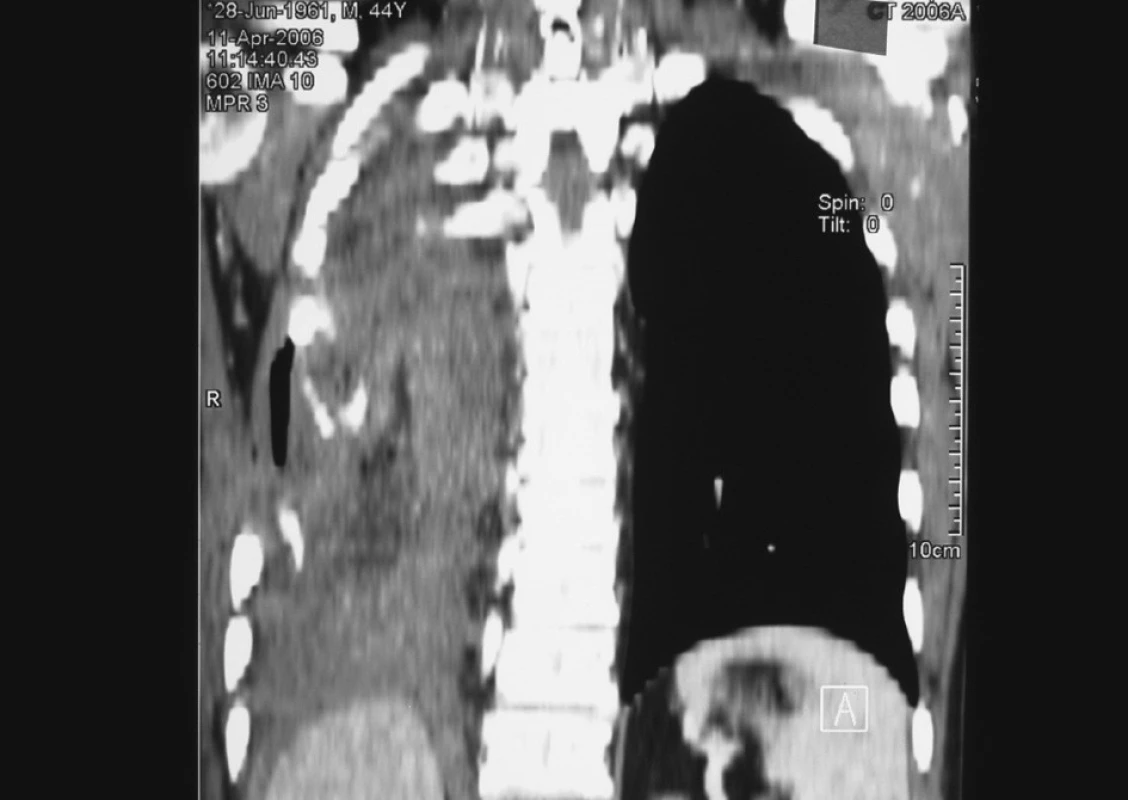 CT obraz dokumentuje vyplnenie zbytkovej dutiny omentom
Fig. 4. A CT view documents filling of the residual cavity with the omentum