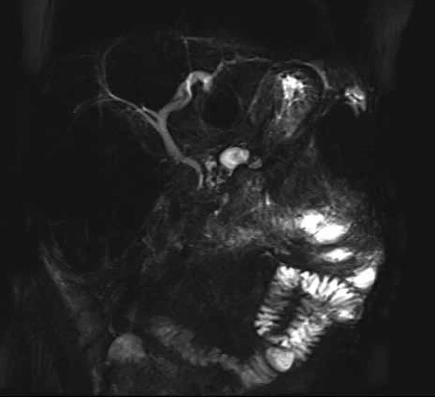 MRCP dva mesiace po extrakcii biliárneho kovového stentu.
Fig. 9. MRCP two months after extraction of biliary metallic stent.