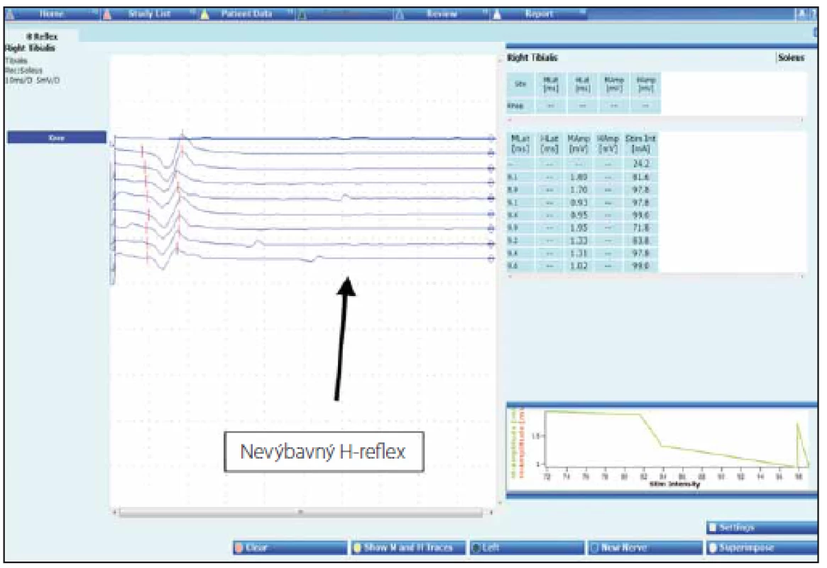H-reflex u Guillain-Barré syndromu.
Fig. 5. H-reflex in Guillain-Barré syndrome.