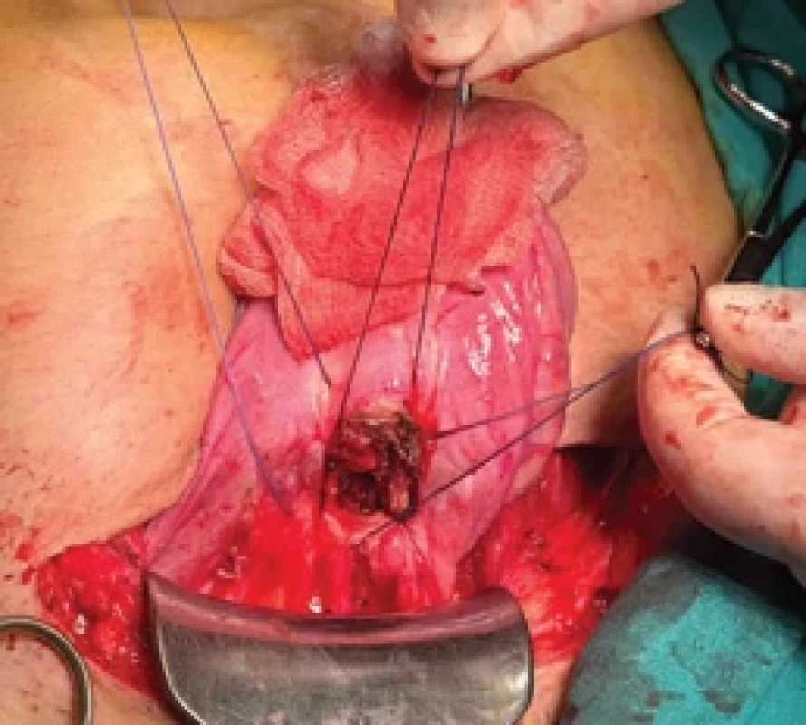 Intraoperative view of the sutured defect after wedge resection. Obr. 3. Intraoperační pohled na sešitý defekt po klínové resekci.