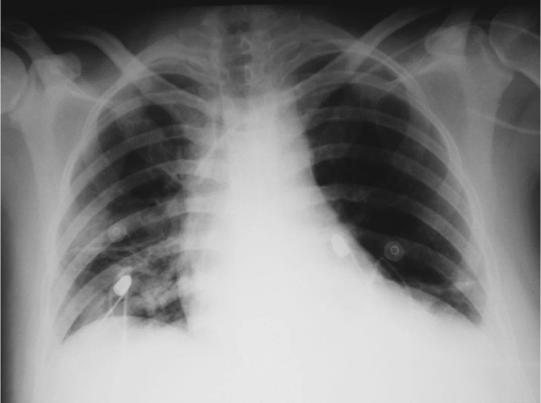 RTG plic – po drenáži obou hemitoraxů
Fig. 4. Pulmonary x-ray – following drainage of the both hemithoraces