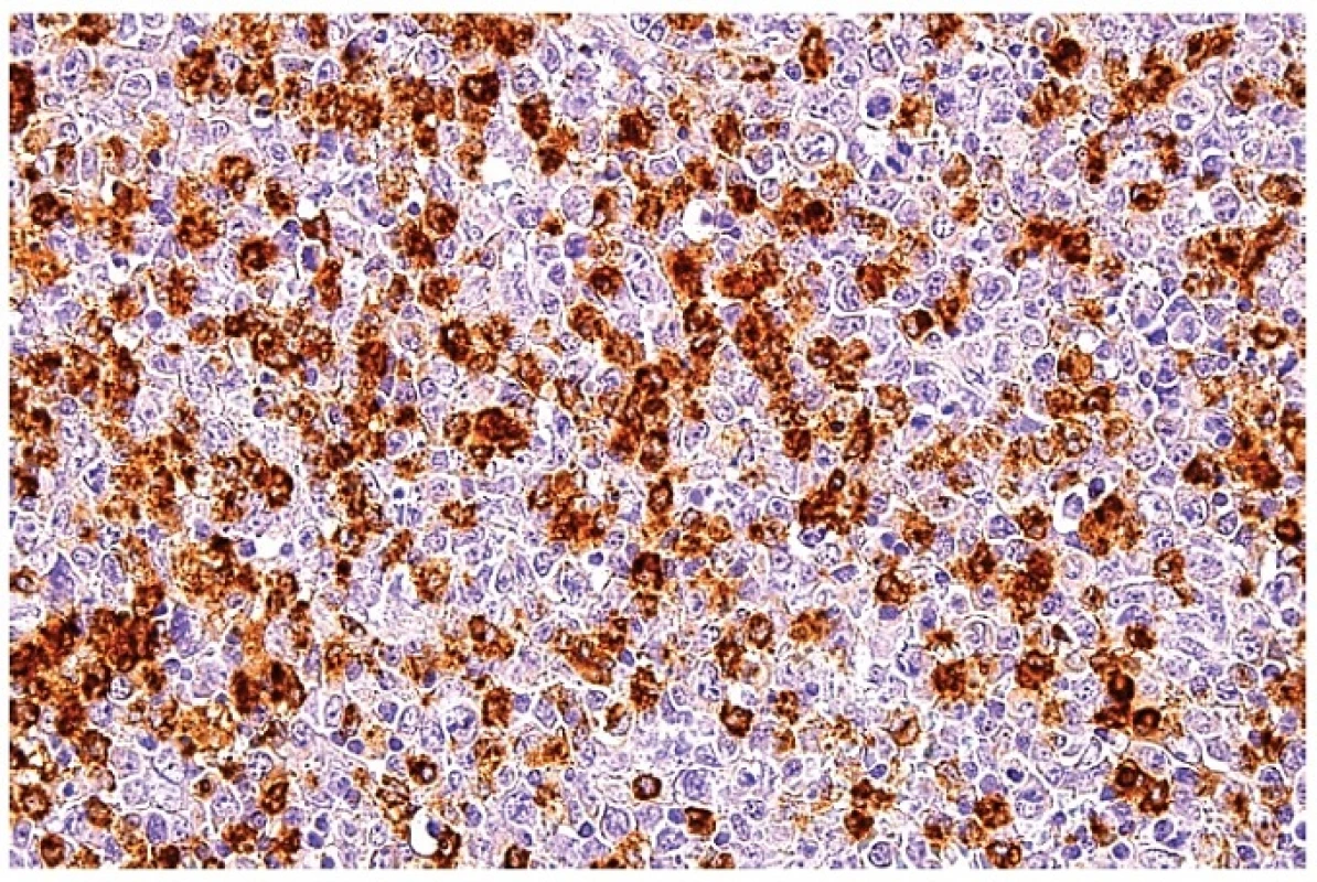 Průkaz MPX v makrofázích ukazuje silnou cytoplazmatickou reaktivitu. Blasticky aktivované atypické lymfoidní buňky jsou negativní. Imunohistochemická reakce, dobarveno hematoxylinem (zvětšení 200x).
