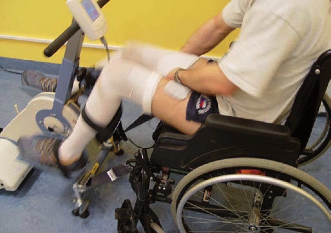 Příklad funkční elektrické stimulace v kombinaci s bicyklovým ergometrem.
Elektrody jsou umístěny na kvadricepsech, hamstringách a gluteích.
Fig. 14. An example of functional electric stimulation in combination with a bicycle ergometer.
Electrodes are placed on the quadriceps, and hamstrings and gluteal muscles.