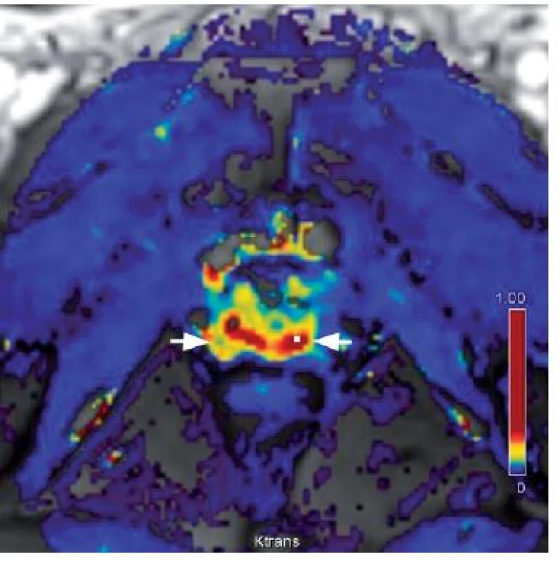Dynamické kontrastní zobrazení – hypervaskularizace v periferní zóně (bílé šipky)
Fig. 3. Dynamic contrast enhancement – colour map of the flow volume shows areas of a higher wash-in rate (hypervascularization) in the dorsal peripheral zone (white arrows) than in other areas