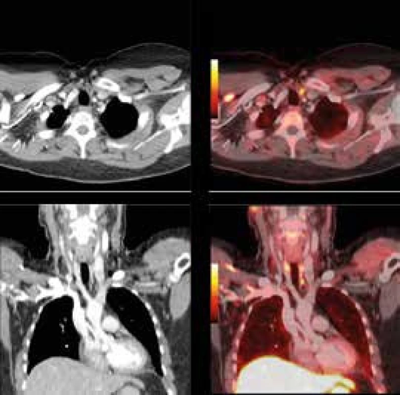Zobrazení příštítného tělíska <sup>18</sup>F-fluorocholinem (FCH) PET-CT