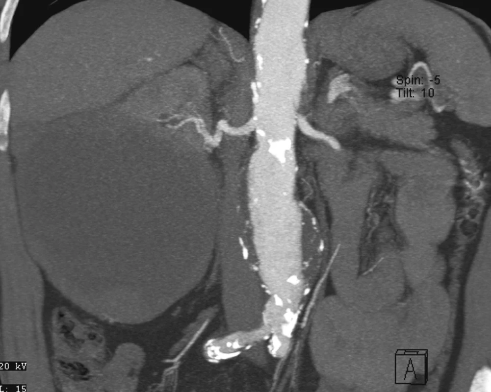 CTA obraz tumoru pravé ledviny a AAA
Fig. 6. CTA view of the right kidney tumor and AAA