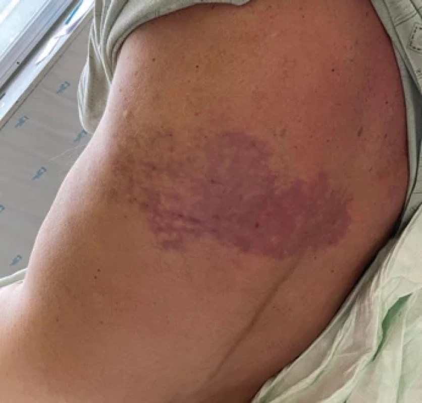 Skin changes in dermatomes T8-9 on the left side of the back mimicking infectious etiology.