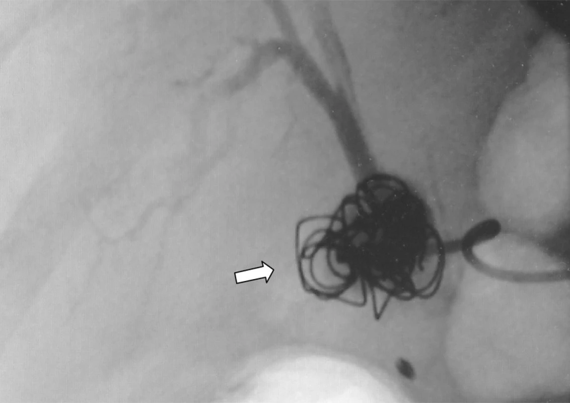 Angiografie truncus coeliacus: pseudoaneurysma po téměř kompletní okluzi coily (označeno šipkou) 
Fig. 4. Angiography of the truncus coeliacus: the pseudoaneurysm following a nearly complete coil occlusion (marked by an arrow) 