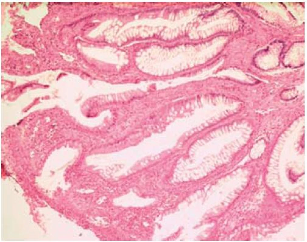 Fibromusculární obliterace.
Fig. 5. Fibro-muscular mucosal obliteration.