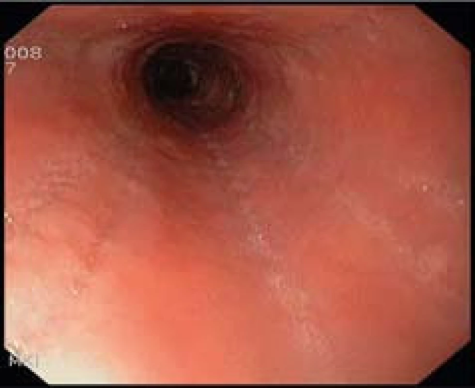 Endoskopický obraz zúženého lumen jícnu s podélnými rýhami u pacienta s dg. EoE.
Fig. 5. Endoscopic image of narrow esophageal lumen with longitudinal furrows in a patient with EoE.