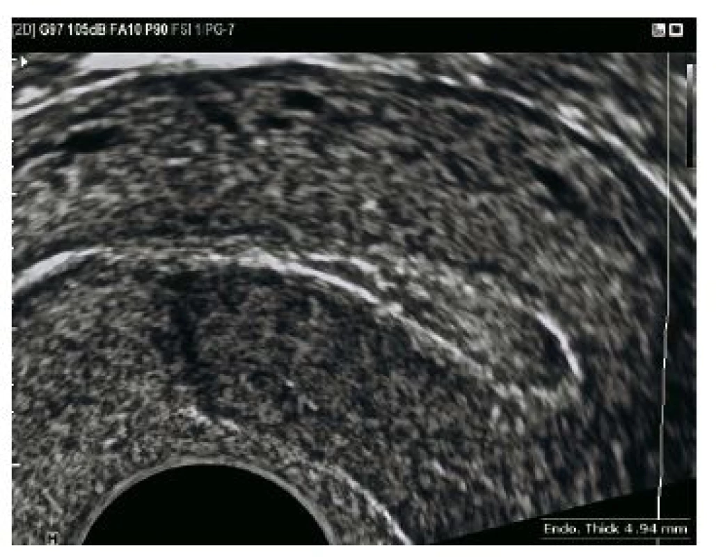 Endometrium je homogenní, nízké – 4,92 mm, bez známek intrauterinní gravidity