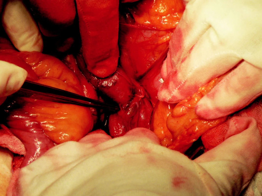 Peroperačný snímok
Fig. 5. Intraoperative view