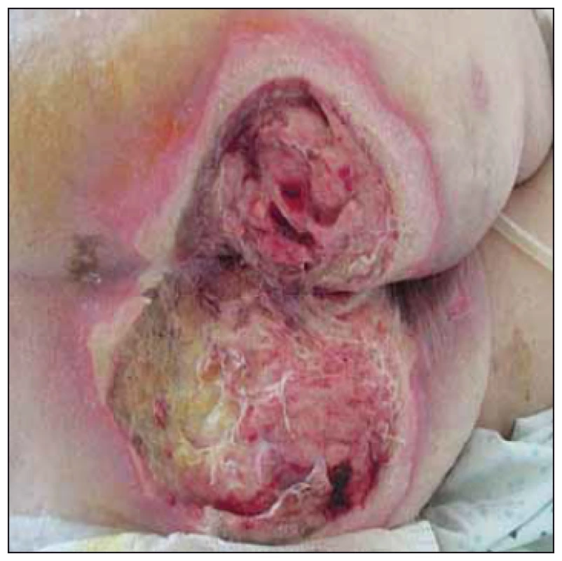 Case study A – 14<sup>th</sup> postoperative day, pressure ulcers – National Pressure Ulcer Advisory Panel (NPUAP) IV. category.<br>
Obr. 1. Klinický prípad A – 14. pooperačný
deň, dekubitus IV. stupeň podľa National
Pressure Ulcer Advisory Panel (NPUAP).