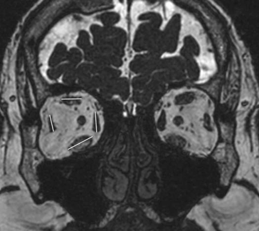 Znázornění měření dlouhých průměru okohybných svalů (pro přehlednost znázorněno na jednom MRI skenu). Každý sval byl v praxi měřen v místě své největší šířky na rekonstrukci v rovině kolmé k průběhu dlouhé osy orbity.